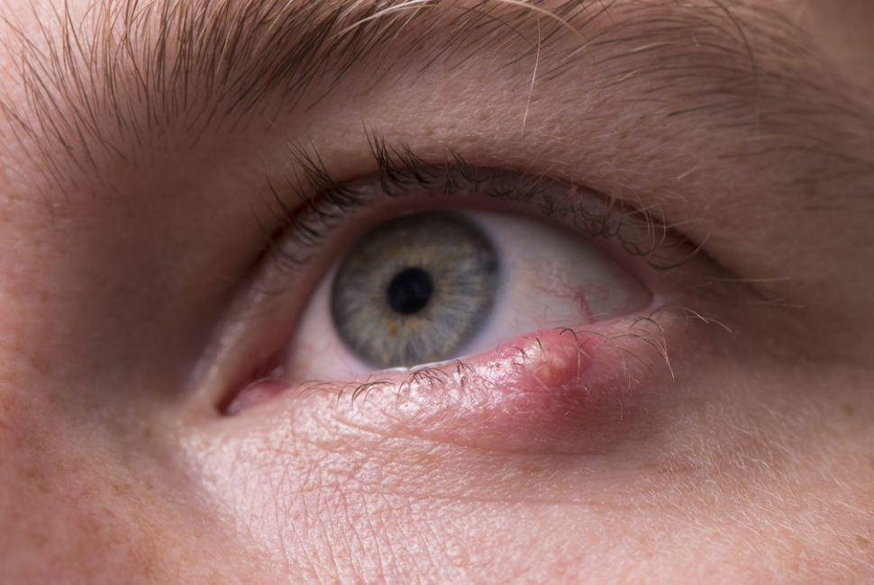 Hordéolo ou Terçolho no olho - o que é, causas, tratamento, cura