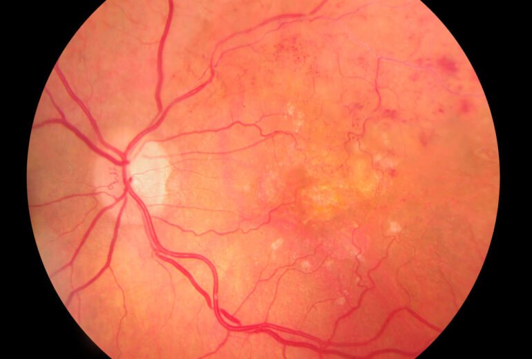 Você já ouviu falar sobre o descolamento de retina? Neste artigo nós responderemos as principais dúvidas sobre o tempo.