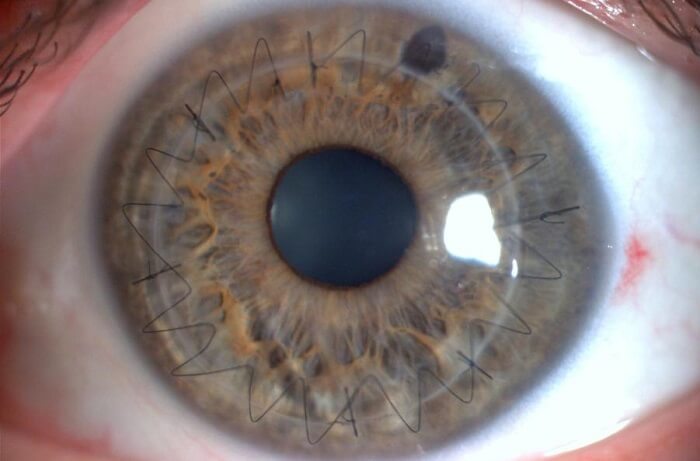 A córnea é um tecido transparente que fica na parte da frente do olho, como se fosse uma película protetora.