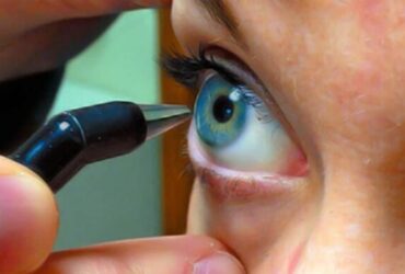 O exame de paquimetria é feito para medir a espessura da córnea, que é a parte transparente do olho, pela qual visualizamos a íris, a pupila e o fundo ocular. 