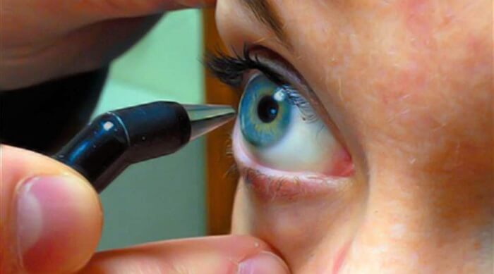O exame de paquimetria é feito para medir a espessura da córnea, que é a parte transparente do olho, pela qual visualizamos a íris, a pupila e o fundo ocular. 