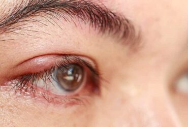 O terçol é uma condição oftalmológica comum, que pode afetar pessoas de todas as idades. Embora não seja uma condição grave