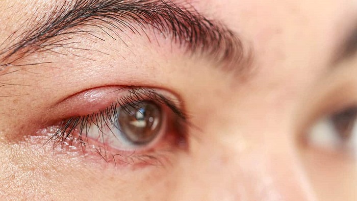 O terçol é uma condição oftalmológica comum, que pode afetar pessoas de todas as idades. Embora não seja uma condição grave