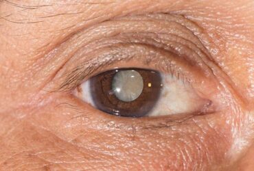 Segundo o Conselho Brasileiro de Oftalmologia, das 45 milhões de pessoas no mundo que são cegas, 40% delas perderam a visão devido à catarata, uma doença que atinge especialmente as pessoas na terceira idade, devido às mudanças que ocorrem em todo o corpo, inclusive nos olhos.