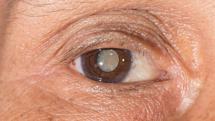 Segundo o Conselho Brasileiro de Oftalmologia, das 45 milhões de pessoas no mundo que são cegas, 40% delas perderam a visão devido à catarata, uma doença que atinge especialmente as pessoas na terceira idade, devido às mudanças que ocorrem em todo o corpo, inclusive nos olhos.