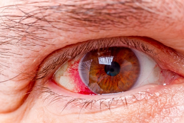 O glaucoma é uma das doenças oculares que mais afeta indivíduos no mundo inteiro – a Organização Mundial da Saúde (OMS) estima que quase 65 milhões de pessoas entre 40 e 80 anos tenham glaucoma, e no Brasil, segundo o Ministério da Saúde, em 2021, 900 mil pessoas tinham o diagnóstico dessa doença crônica, que, se não for tratada adequadamente, pode resultar na perda da visão.