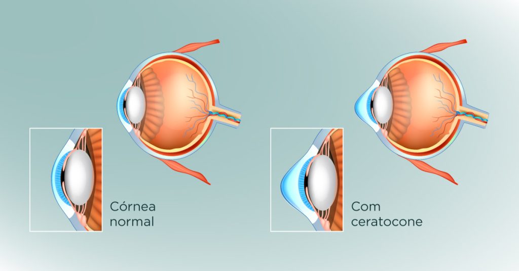 ceratocone