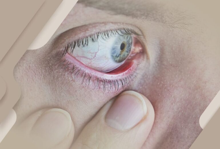 doenças oculares