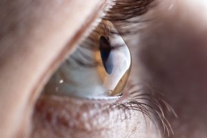 5 Opções de Tratamento para Ceratocone