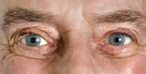 descolamento de retina