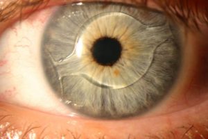 Lentes intraoculares: quando são recomendadas?
