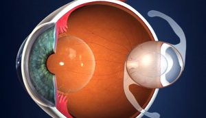 Lentes intraoculares: Quais características e quando é indicado