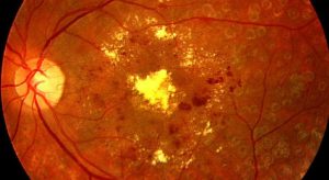 Diabetes e visão: como prevenir a retinopatia diabética